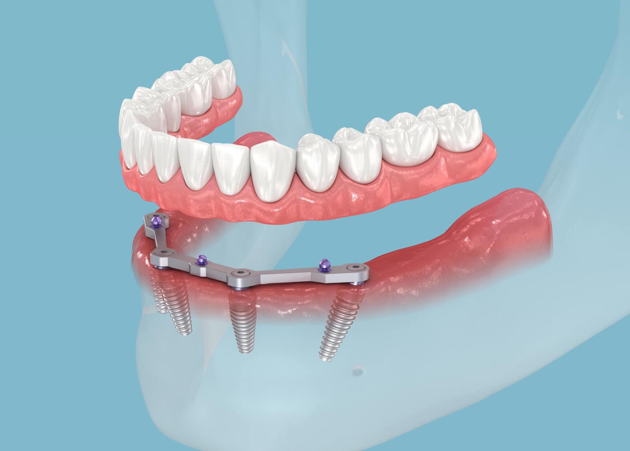 All-on-4 Dental Treatment